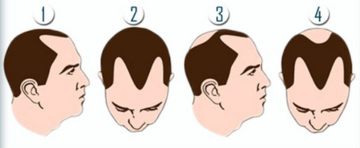 Hair Transplant Wakefield